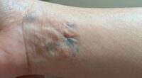 swelling mimicking illness